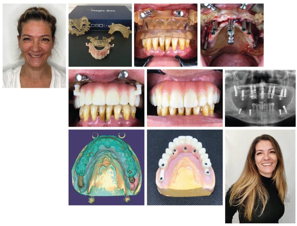 Cirug A Guiada Dsd Y Carga Inmediata Con Implantes Treeoss Hs Dr